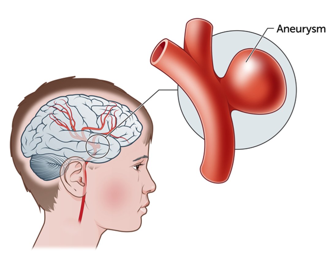 Aneurysm Clipping/Coiling Image