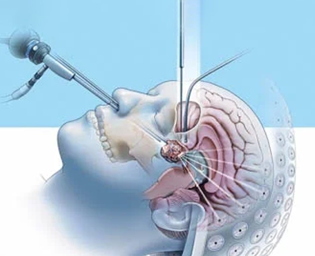Skull Base Surgery Image
